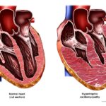 Miocardiopatía hipertrófica