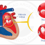 Prolapso de la válvula mitral