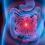 Síndrome del intestino corto