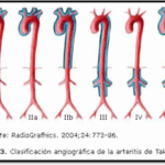Vasculitis de Takayasu