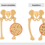 Raquitismo: descripción médica completa
