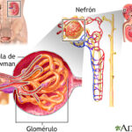Síndrome nefrótico