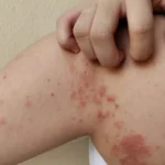 Lepra (Enfermedad de Hansen)