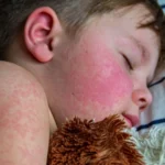 Rubeola (Sarampión): Descripción Completa