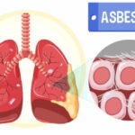 Asbestosis