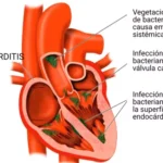 Endocarditis