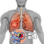 Alveolitis alérgica extrínseca
