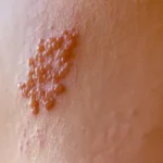 Herpes zóster: explicación completa