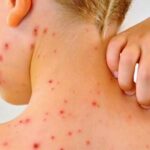 Sarampión: explicación clara y completa