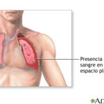 Hemotórax: explicación completa y clara