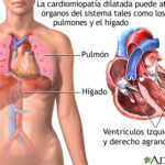 Miocardiopatía dilatada: explicación completa y clara