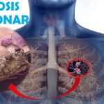 FIBROSIS PULMONAR