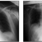 Neumonía por aspiración