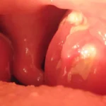 Mononucleosis infecciosa