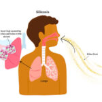 Silicosis