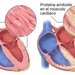 Amiloidosis Cardíaca
