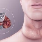 Bocio: explicación completa