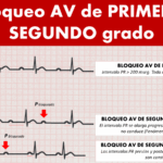 Bloqueo AV: explicación completa