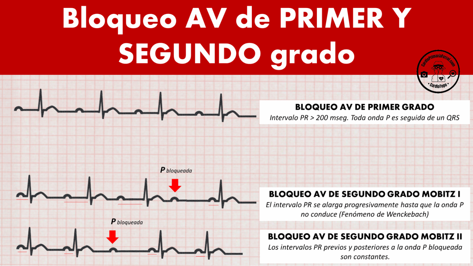 Bloqueo AV Explicaci n Completa