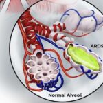 SÍNDROME DE DISTRÉS RESPIRATORIO AGUDO (SDRA)