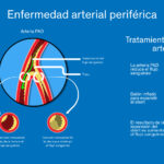 ENFERMEDAD ARTERIAL PERIFÉRICA (EAP)