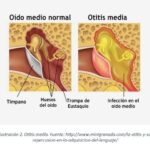 Otitis media
