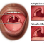 Faringitis estreptocócica