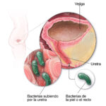 Infección urinaria: causas, síntomas, diagnóstico, tratamiento y medidas de prevención más importantes