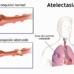 Atelectasia: definición, causas, manifestaciones clínicas y manejo