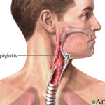 Epiglotitis: una inflamación grave de la vía aérea superior que requiere atención inmediata