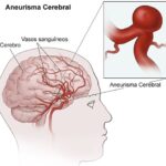 Aneurisma cerebral: qué es, por qué ocurre, cómo se manifiesta y cuáles son sus opciones de tratamiento