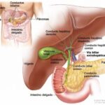 Colangitis: inflamación e infección de las vías biliares, causas, síntomas y tratamiento