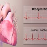 Bradicardia sinusal