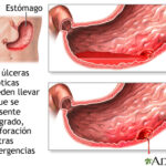Úlcera péptica: causas, mecanismos, manifestaciones clínicas, diagnóstico, tratamiento y prevención