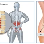 Lumbalgia: causas, síntomas, diagnóstico y abordaje integral
