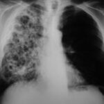 Histoplasmosis pulmonar