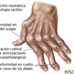 Artritis reumatoide
