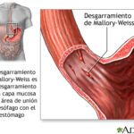 Síndrome de Mallory-Weiss