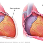 Pericarditis