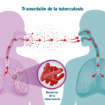 Tuberculosis latente (infección tuberculosa latente)
