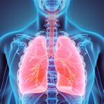Pulmonía intersticial