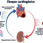 Choque cardiogénico
