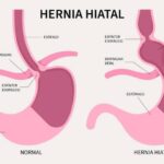 Hernia hiatal: alteración del paso entre el abdomen y el tórax