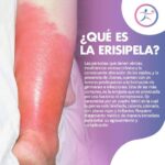 Erisipela: explicación completa y detallada