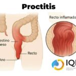 Proctitis