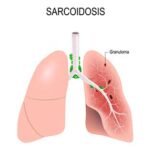 Sarcoidosis: una enfermedad inflamatoria sistémica de origen desconocido