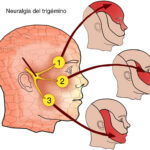 Neuralgia del trigémino: dolor facial intenso de origen neuropático