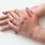 Impétigo: una infección cutánea común, contagiosa y tratable