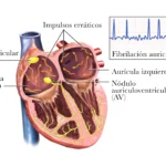 Fibrilación auricular: la arritmia más frecuente y su impacto en la salud cardiovascular