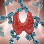 Tiroiditis de Hashimoto: explicación detallada